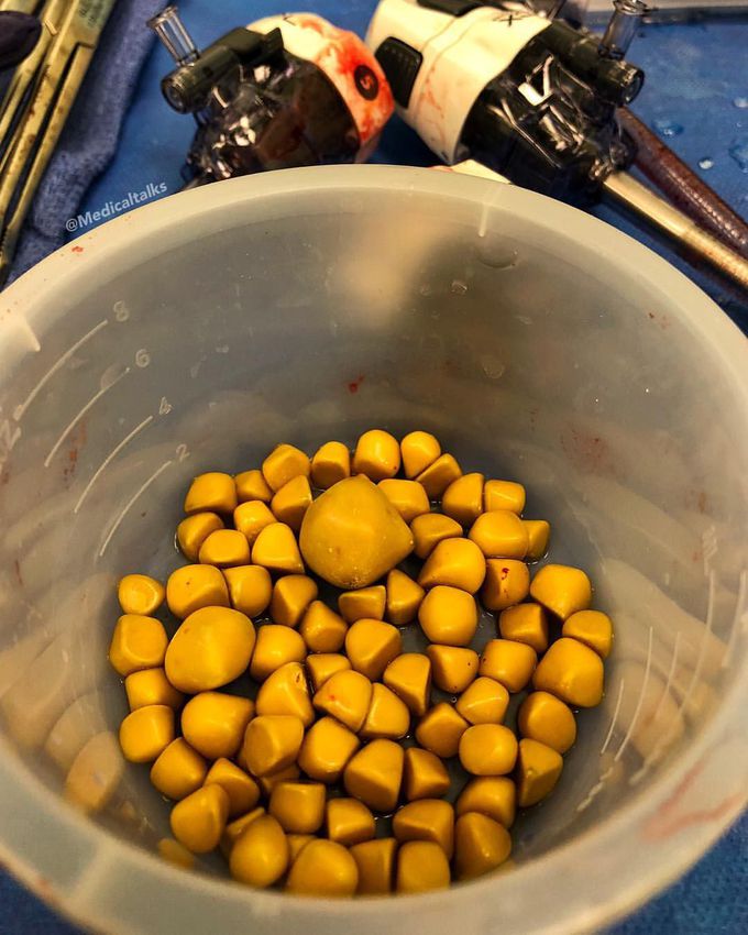 Gallstones