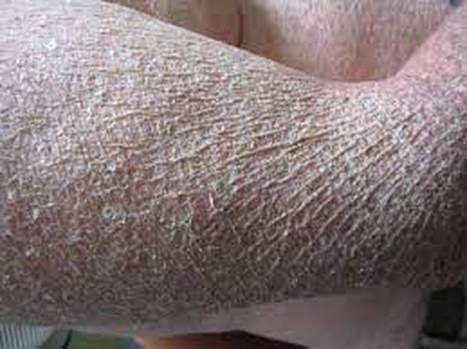 Ichthyosis Vulgaris