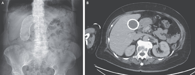 Porcelain Gallbladder In 83-Year-Old
