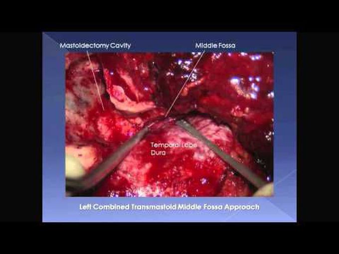 Combined transmastoid middle fossa approach for giant cholesterol granuloma of the petrous apex