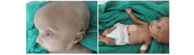 Congenital rubella syndrome