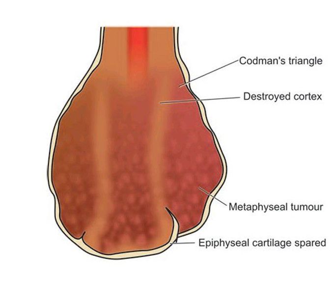 Osteosarcoma