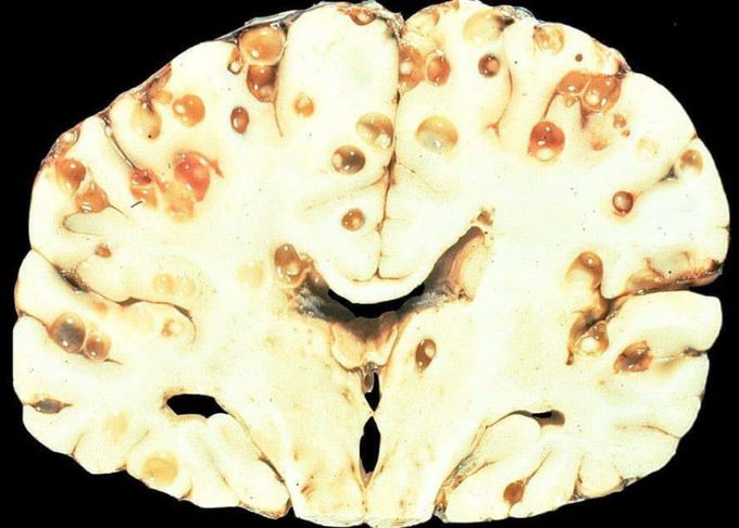 NEUROCYSTICERCOSIS