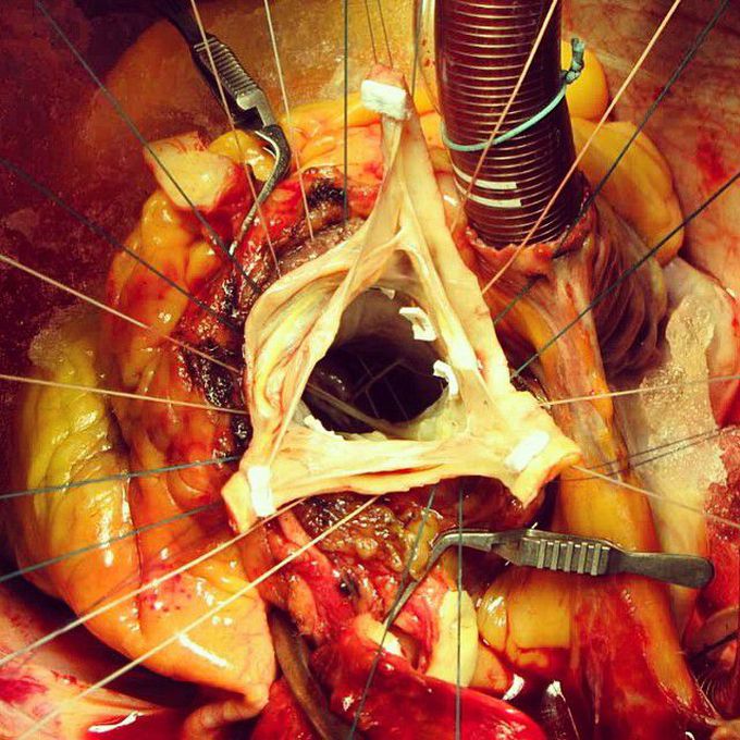 Aortic valve replacement surgery