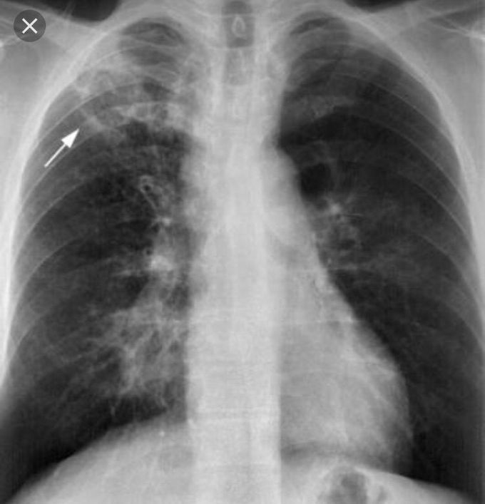 Primary Tuberculosis