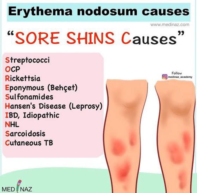 Erythema Nodosum Causes