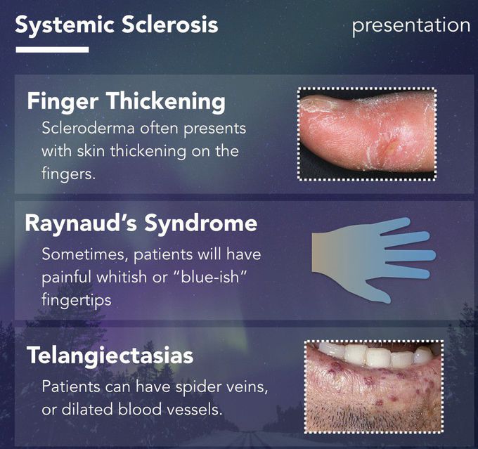Symptoms of systemic sclerosis