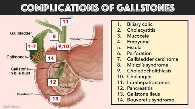 Complications of Gallstones