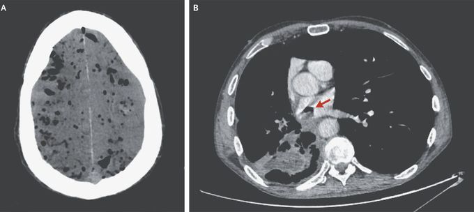 Pneumocephalus Due to a Bronchoatrial Fistula