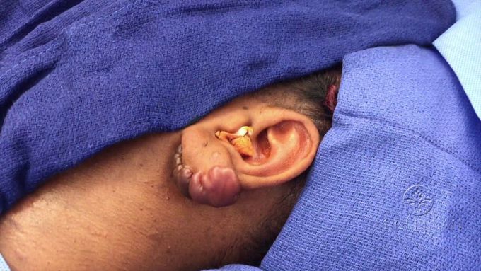 Keloid Resection from the Ear