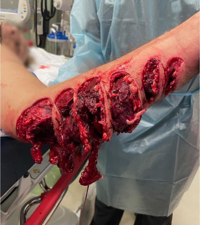 Boat propeller injury, causing deep lacerations across the patients forearm!