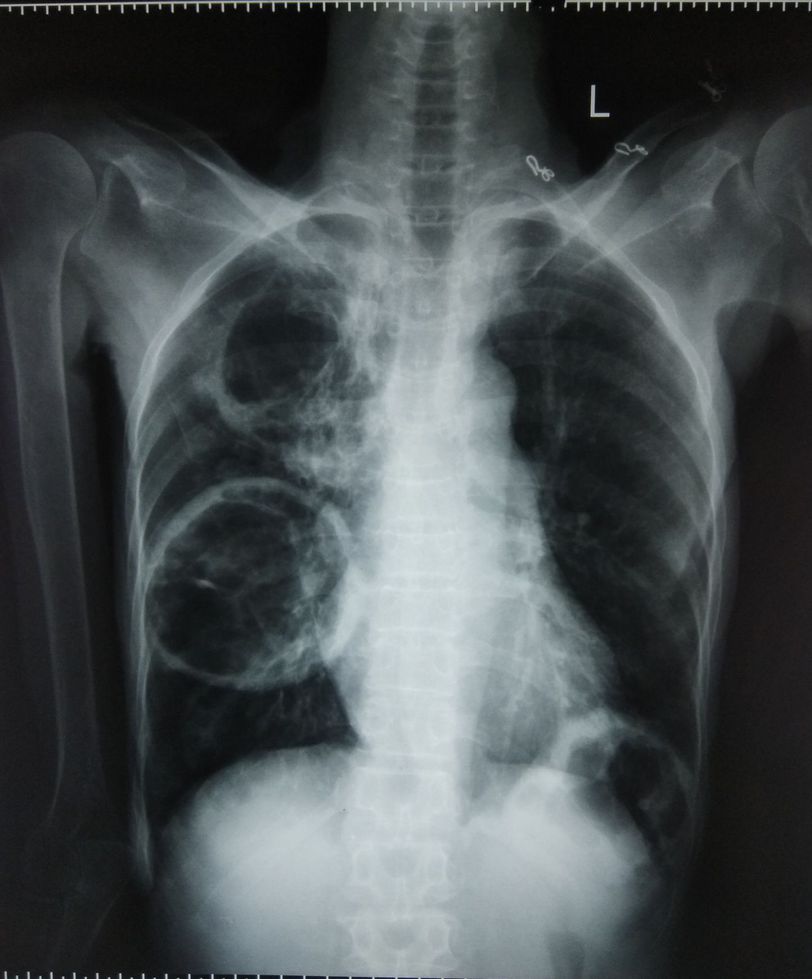 Chest Xray PA view MEDizzy