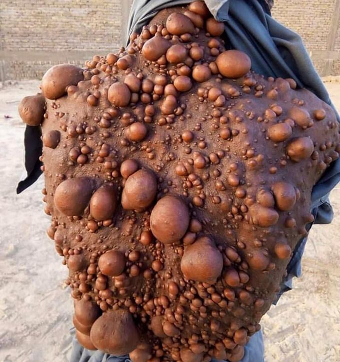 Neurofibromatosis