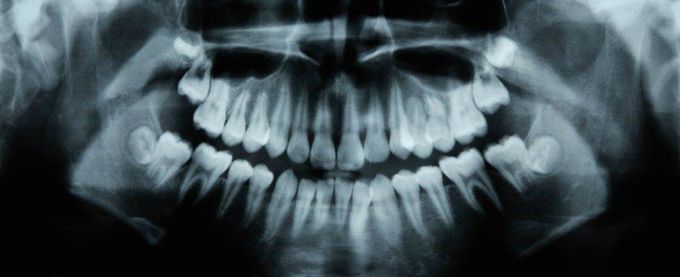 An Alzheimer's Drug Has Been Found to Help Teeth Repair Themselves in Just 6 Weeks