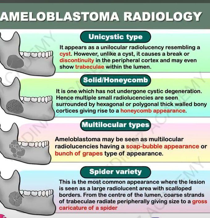 Ameloblastoma-Radiology