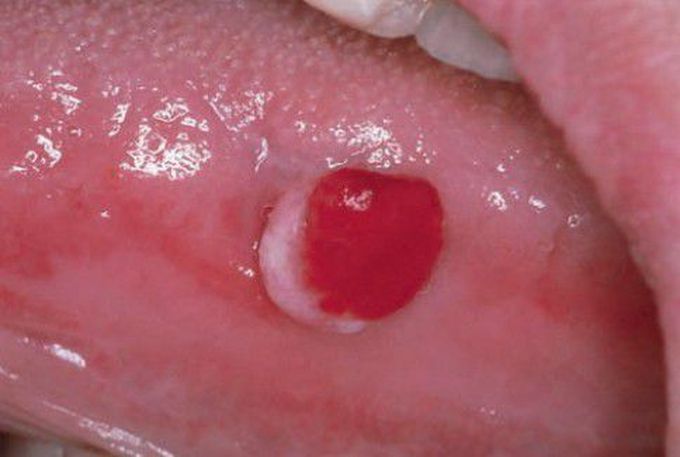 Pyogenic granuloma