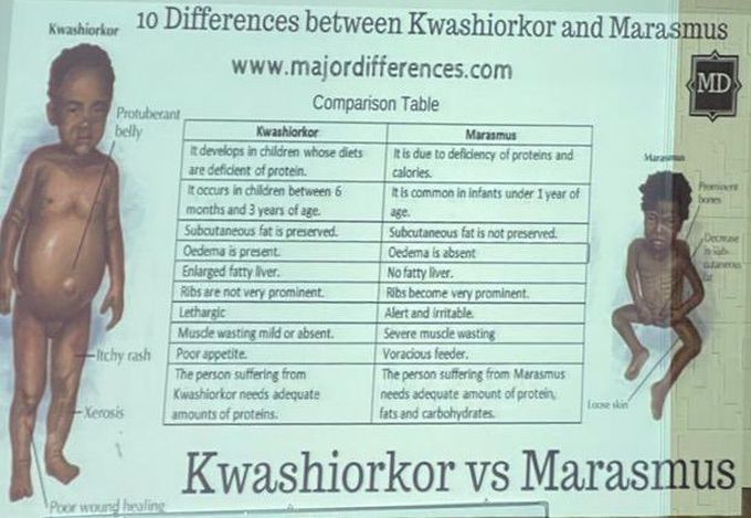 #pediatry #Kwashiorkor#disease#Marasmus#kids#medicine#doctor