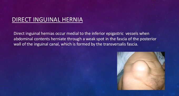 Inguinal hernia