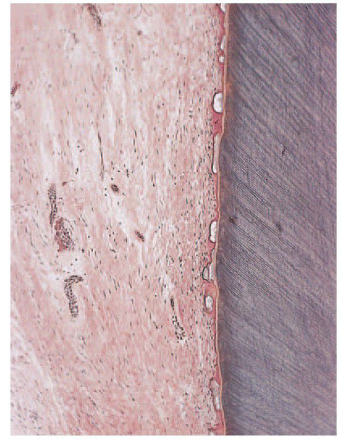 Amelogenesis imperfecta
