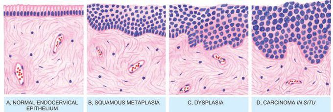 Epithelial changes