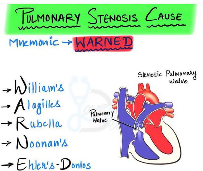 Pulmonary Stenosis-Causes