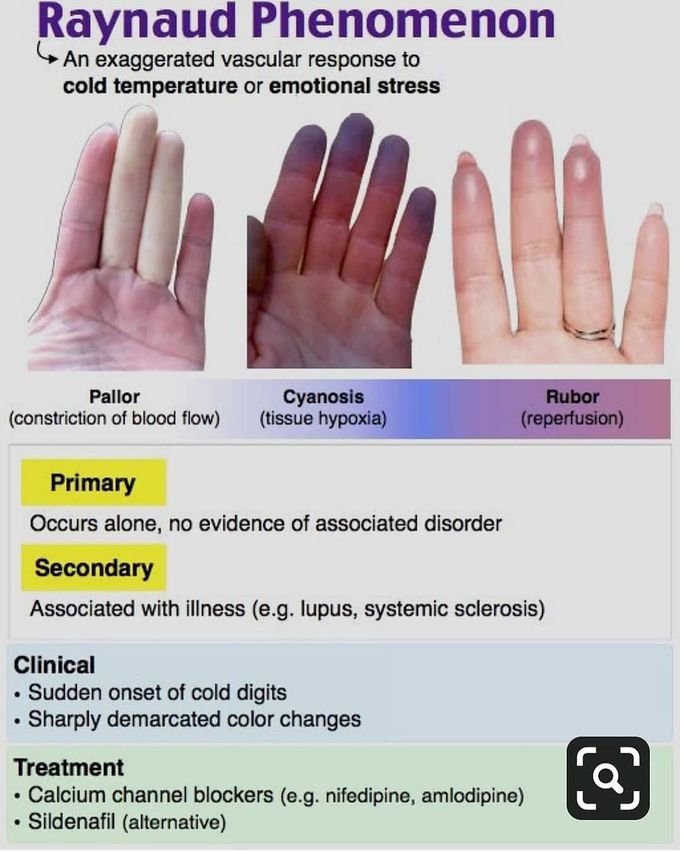 Raynauds phenomenon