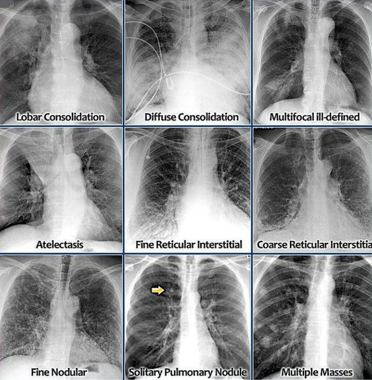 CHEST XRAY INTERPRETATION MEDizzy