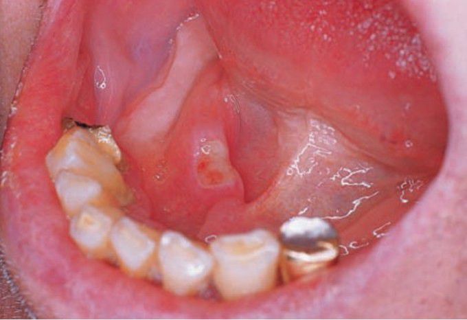 Minor aphthous ulcer (floor of mouth)