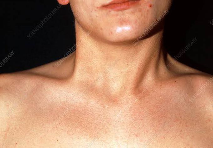 Torticollis