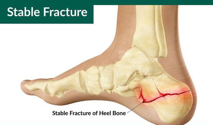 Stable fracture.