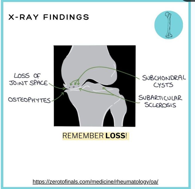 Osteoarthritis VI