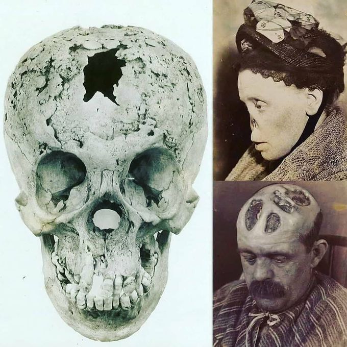 Effect of syphillis on skull