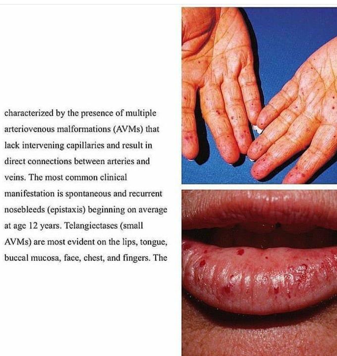 Arteriovenous malformations