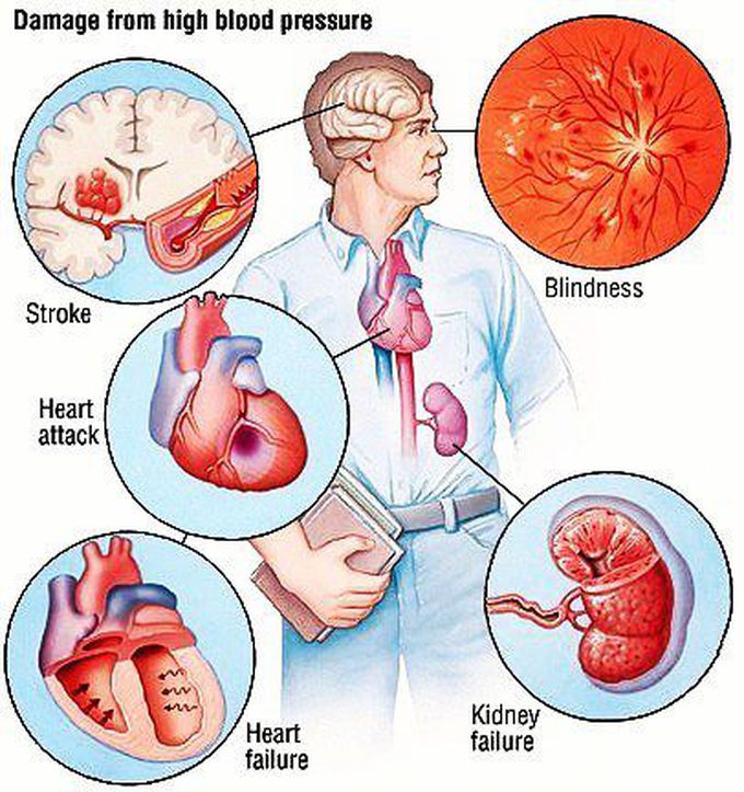 Hypertension