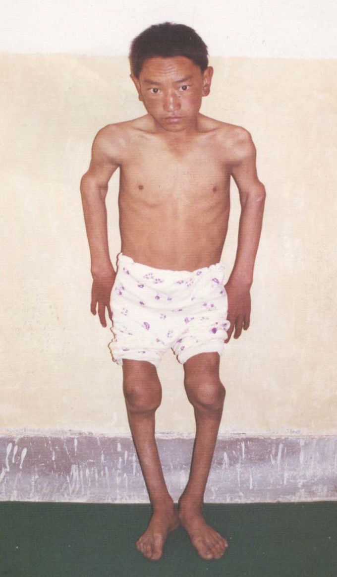 Keshan disease