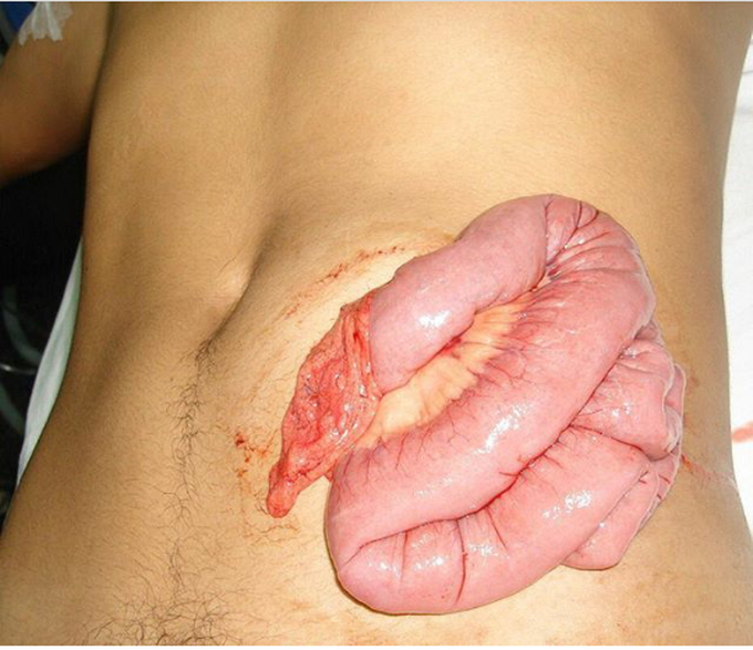 A knife wound to the abdominal wall causing evisceration of bowel 