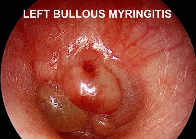 Bullous myringitis