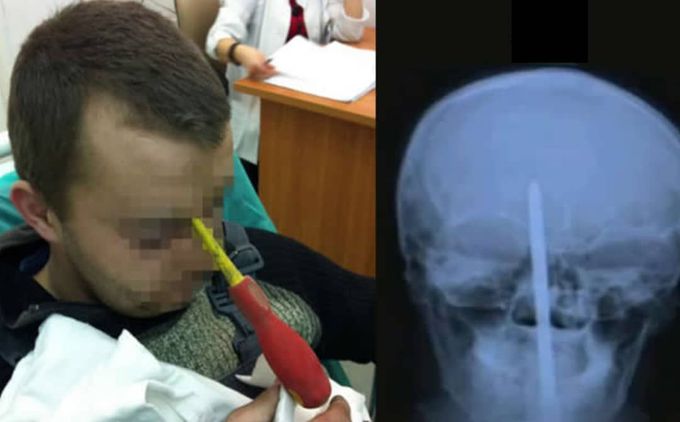 Screwdriver impaled through forehead