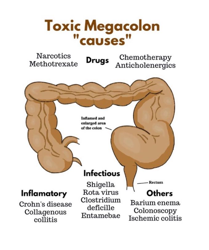 Causes of Toxic Megacolon