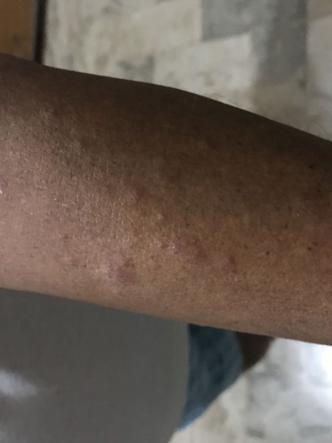 Lesion?