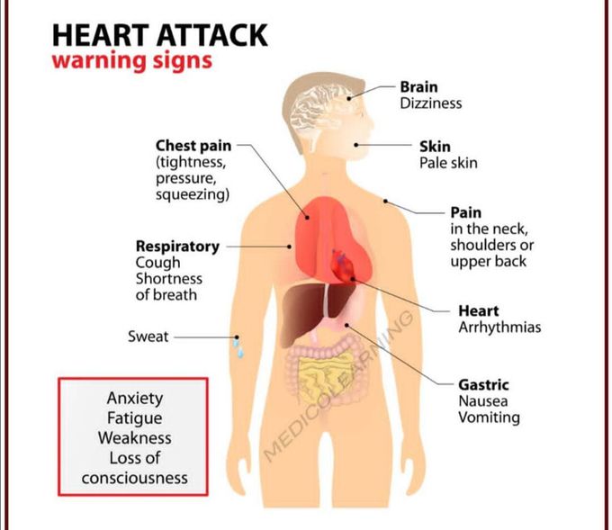 Sign for heart attack
