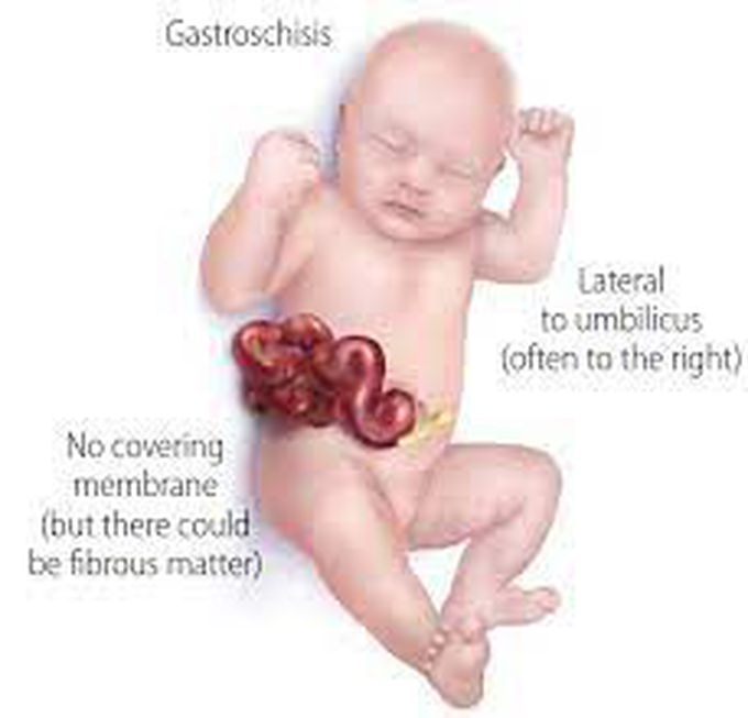 What causes gastroschisis?