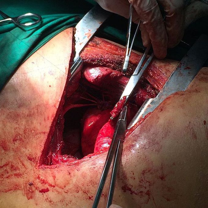 Lung parenchyme entrapment on costal fracture.