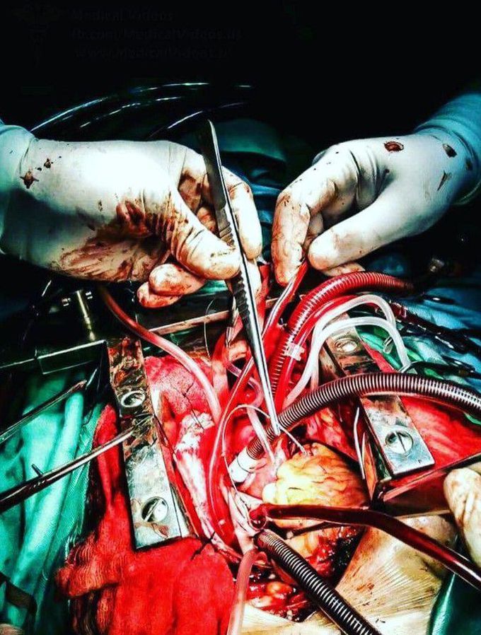 cardiovascular surgery