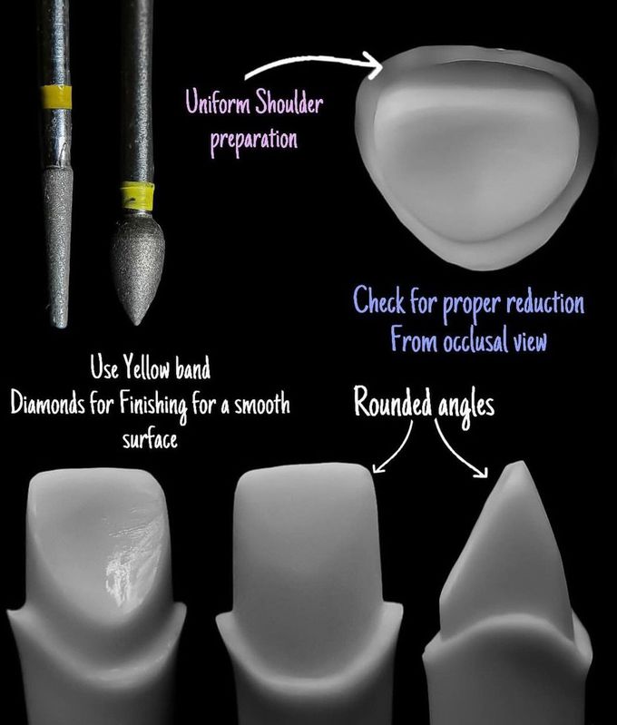 All-Ceramic Crown Tooth Preparation III