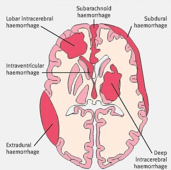 Intracranial hemorrhages