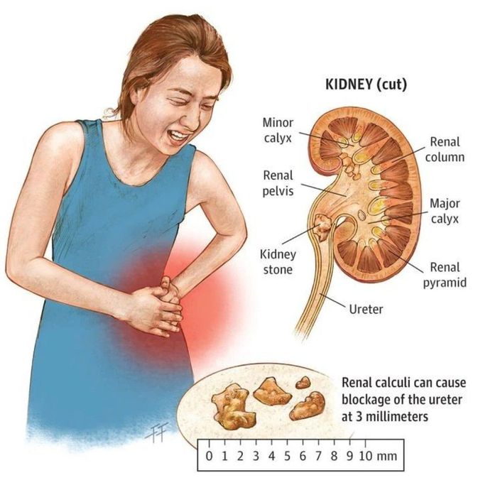 Renal Calculi