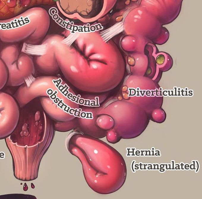 Intestines disorders