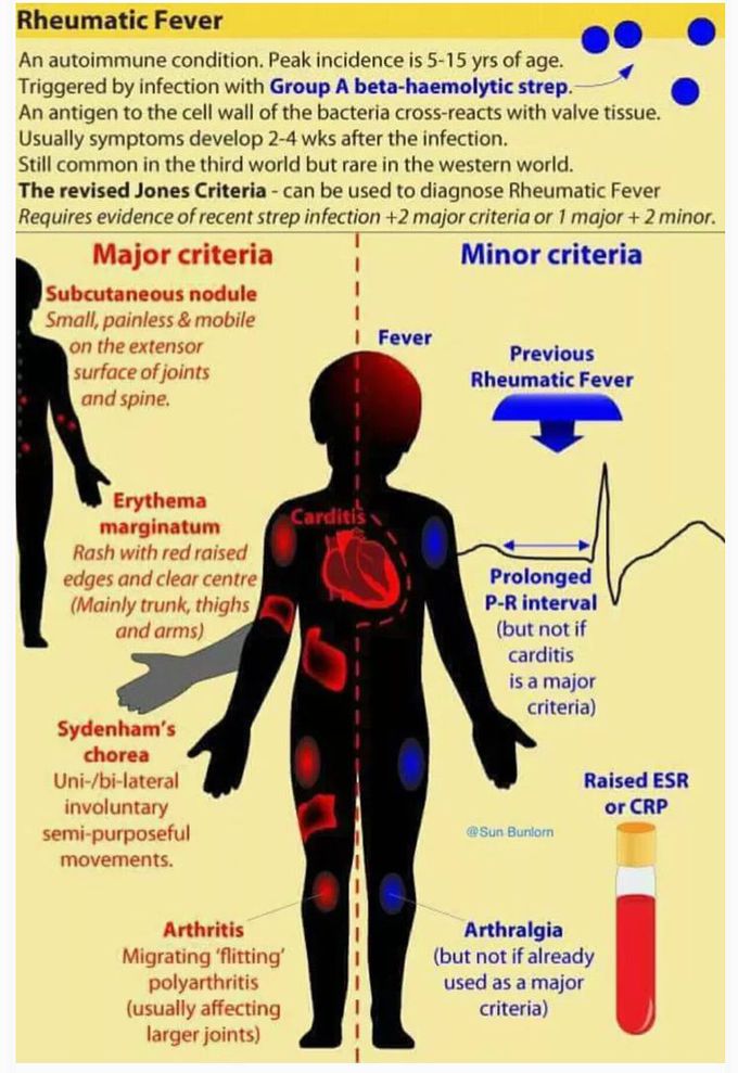 Rheumatic fever