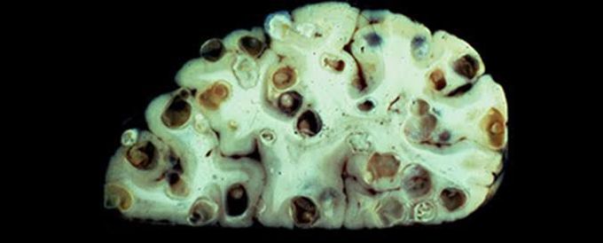 Symptoms of neurocysticercosis